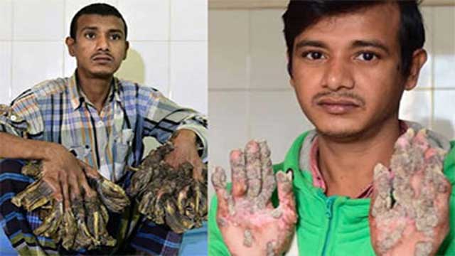 ‘বৃক্ষমানব’-এর চিকিৎসায় ফের মেডিকেল বোর্ড
