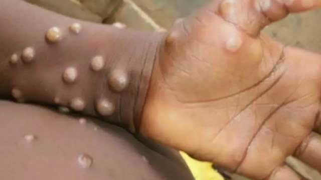 Bangladesh airports, land ports to screen arrivals for monkeypox
